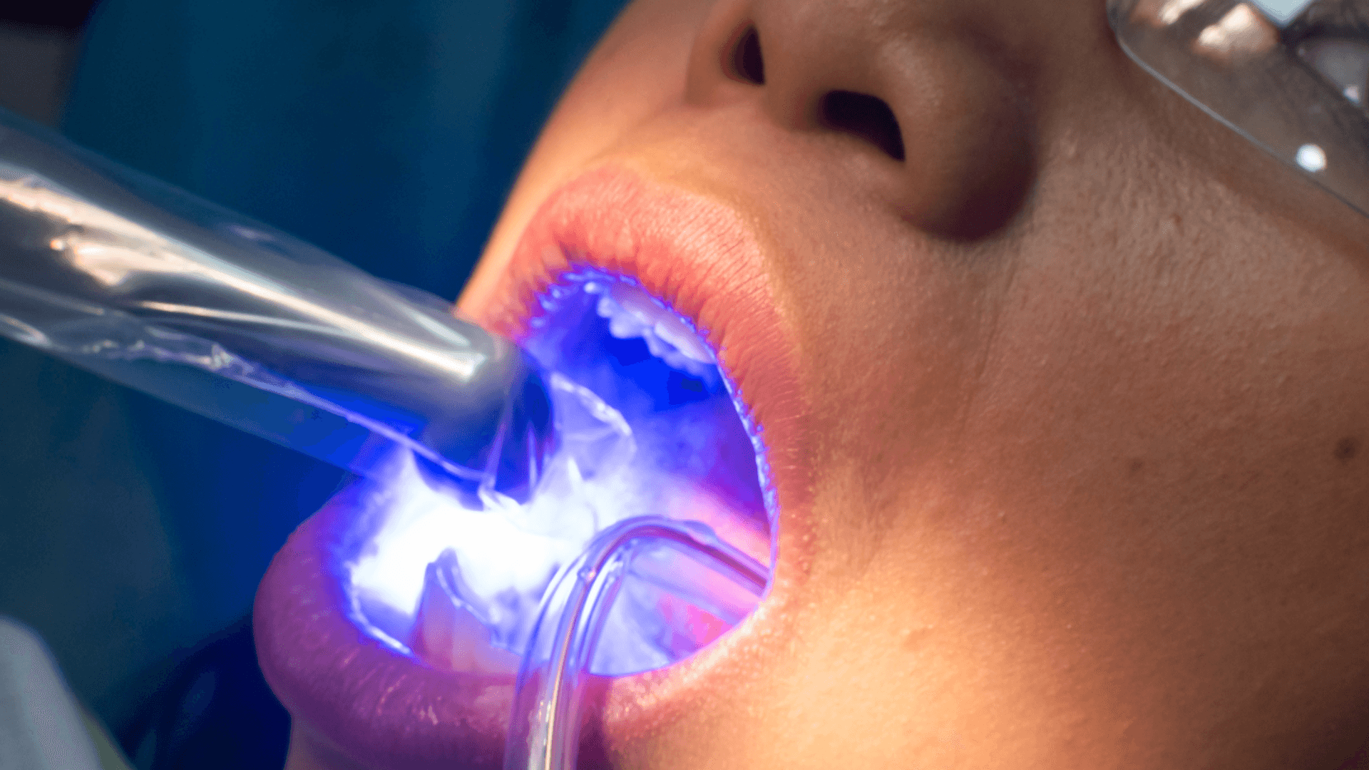 Composite Bonding: Everything You Need to Know