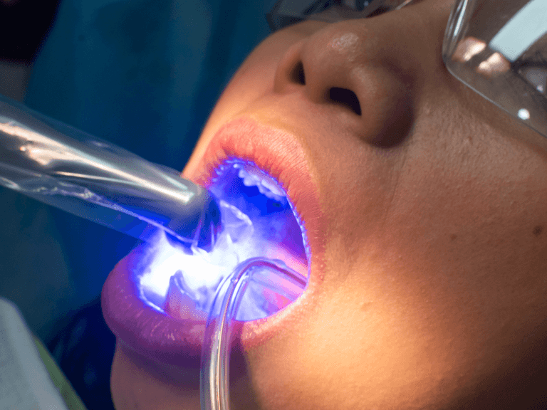 Composite Bonding: Everything You Need to Know