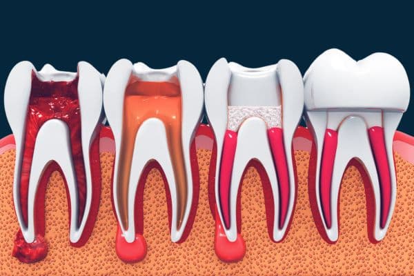 Root canal treatment at Distinctly Dental