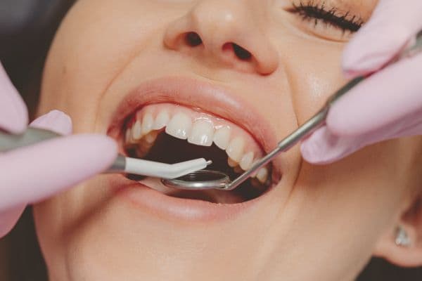 White tooth-coloured filling at Distinctly Dental