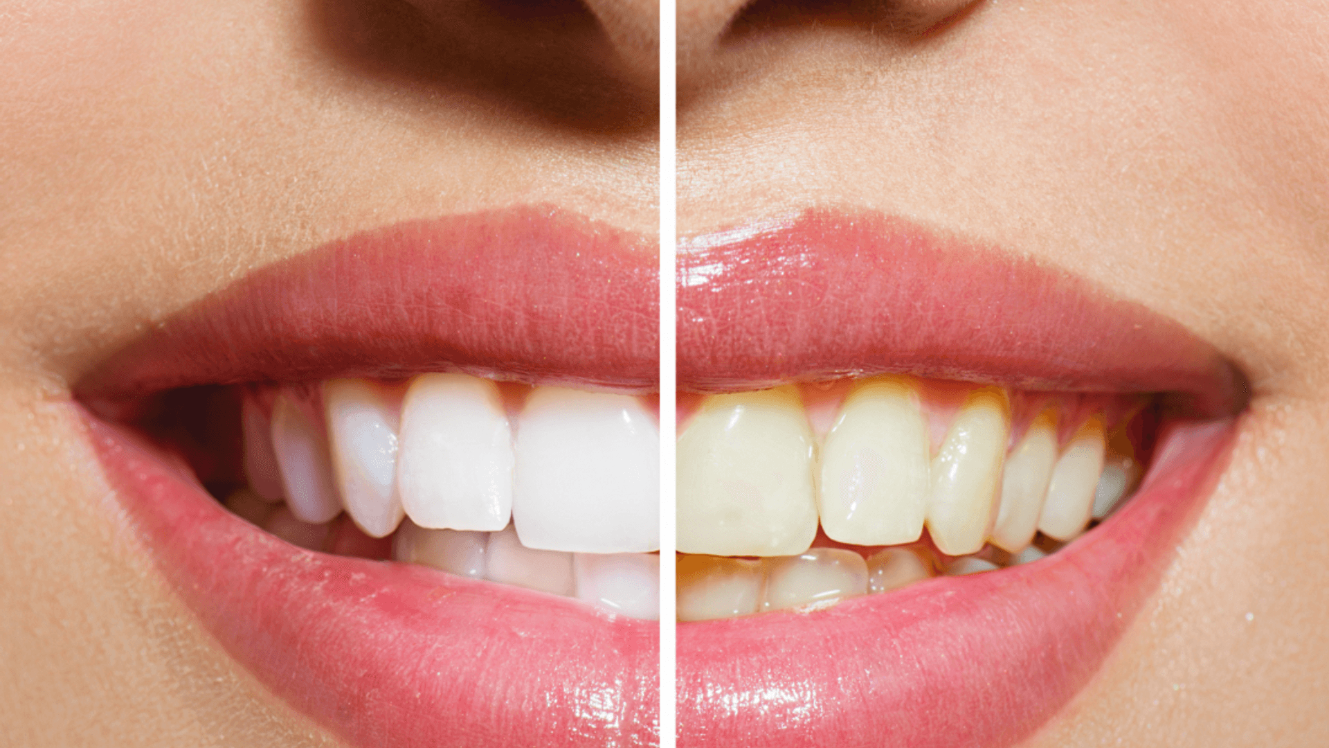 Whitening