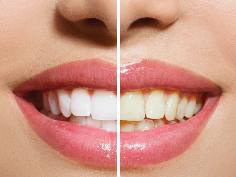 Whitening