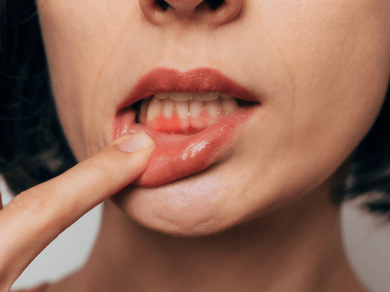 Periodontal Treatment